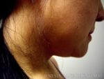 Liposuction Face & Neck