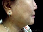 Liposuction Face & Neck