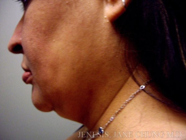 Liposuction Face & Neck