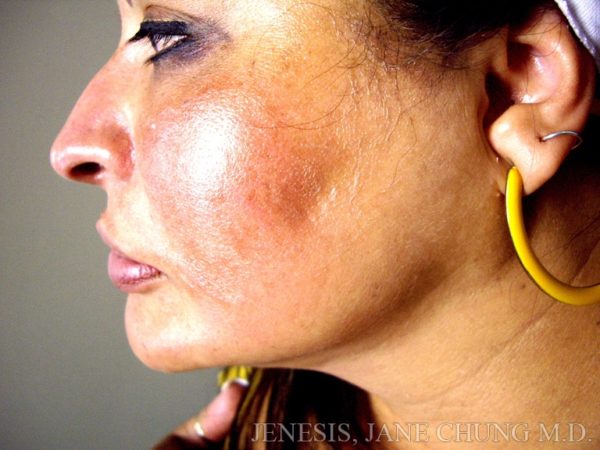 Liposuction Face & Neck