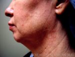 Liposuction Face & Neck