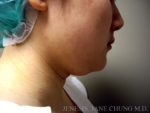 Liposuction Face & Neck