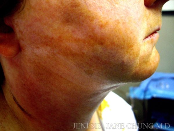 Liposuction Face & Neck