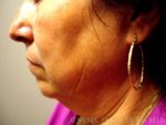 Liposuction Face & Neck