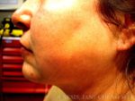 Liposuction Face & Neck