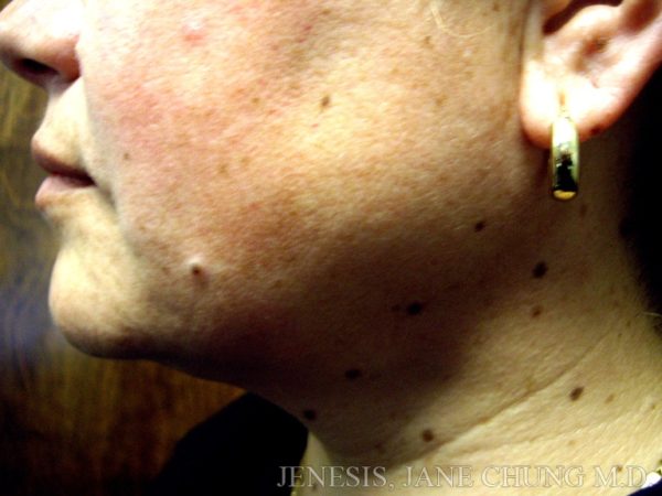 Liposuction Face & Neck