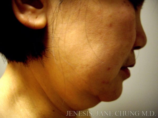 Liposuction Face & Neck
