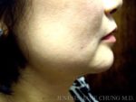 Liposuction Face & Neck