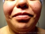 Liposuction Face & Neck