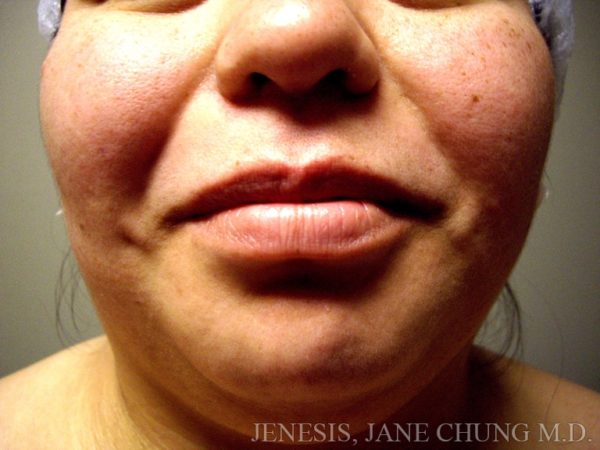 Liposuction Face & Neck