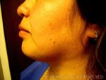 Liposuction Face & Neck