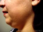 Liposuction Face & Neck