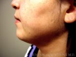 Liposuction Face & Neck