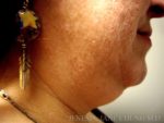 Liposuction Face & Neck