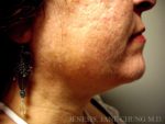 Liposuction Face & Neck