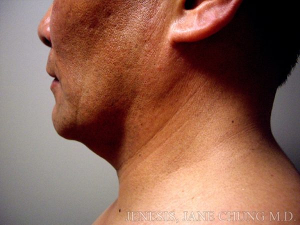 Liposuction Face & Neck