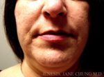 Liposuction Face & Neck