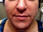 Liposuction Face & Neck