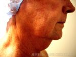 Liposuction Face & Neck