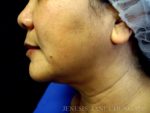 Liposuction Face & Neck