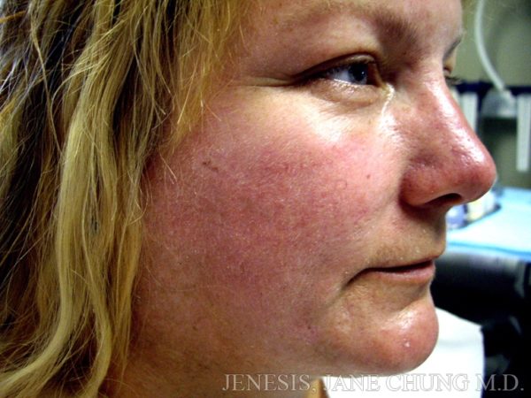 Liposuction Face & Neck