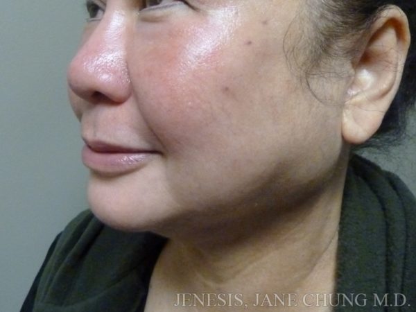 Liposuction Face & Neck