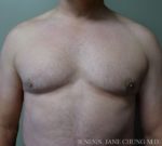 Gynecomastia