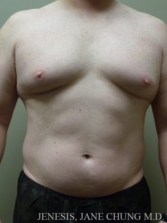 Gynecomastia