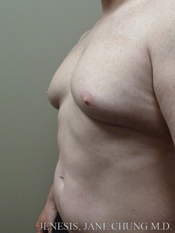 Gynecomastia