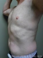 Gynecomastia