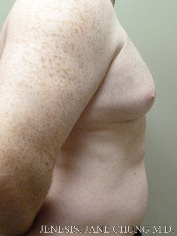 Gynecomastia