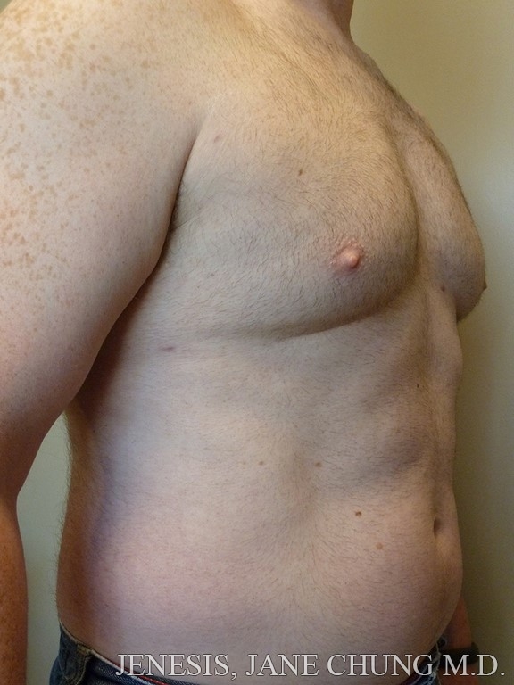 Gynecomastia