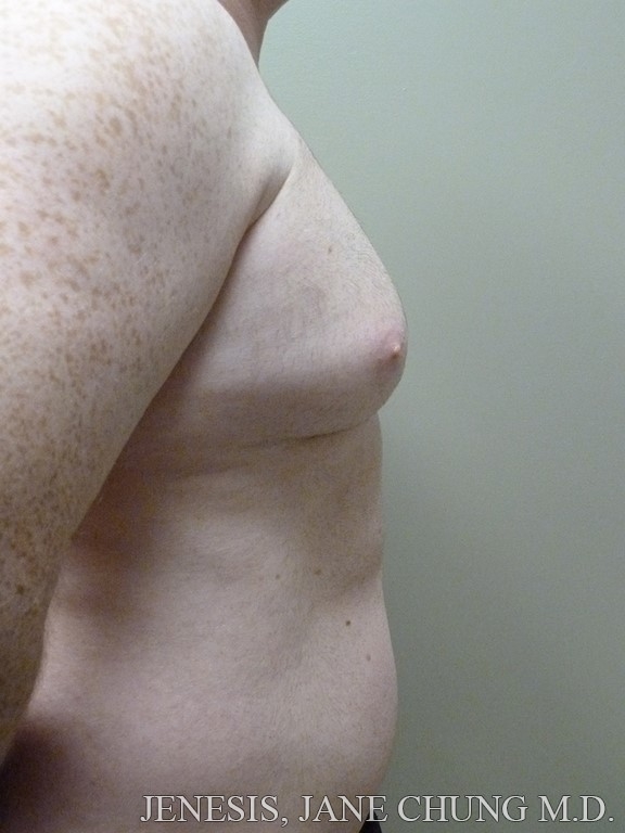 Gynecomastia