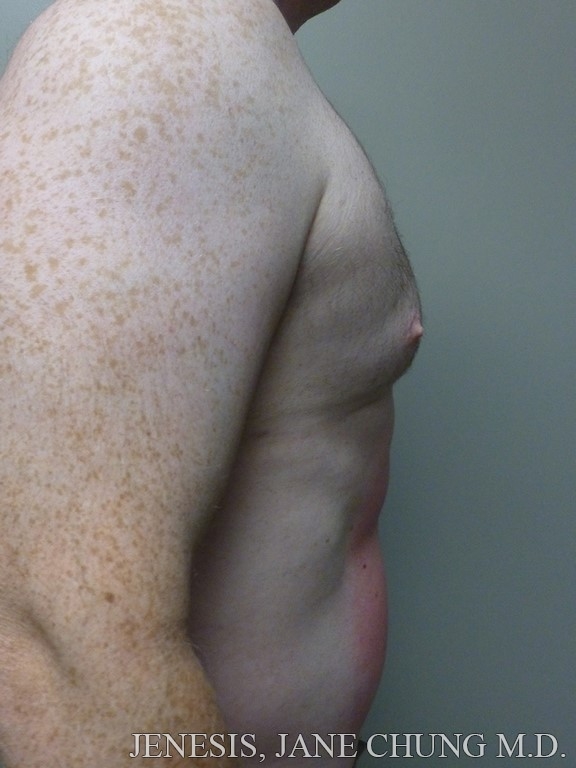 Gynecomastia