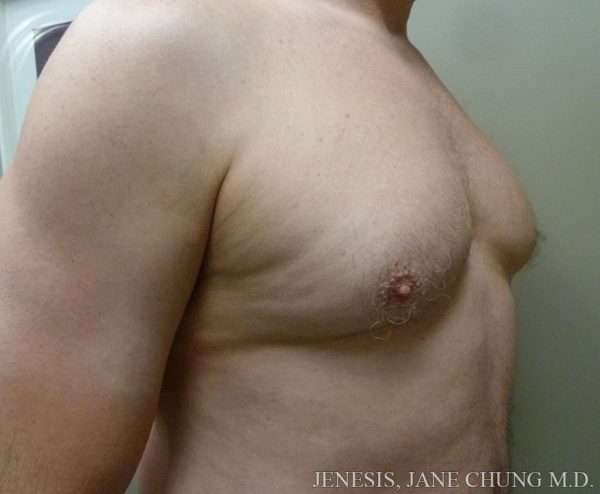 Gynecomastia