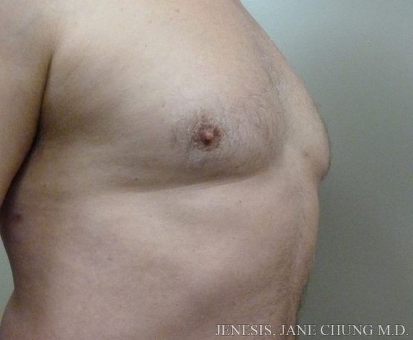 Gynecomastia