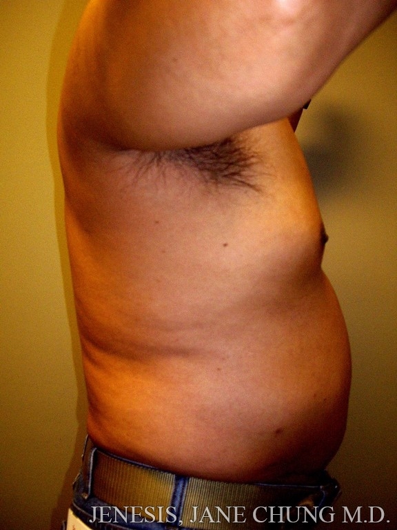 Gynecomastia