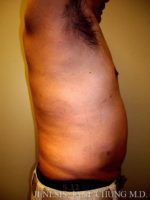 Gynecomastia