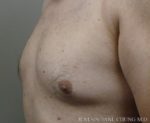 Gynecomastia