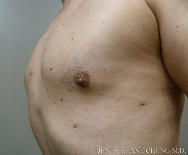 Gynecomastia