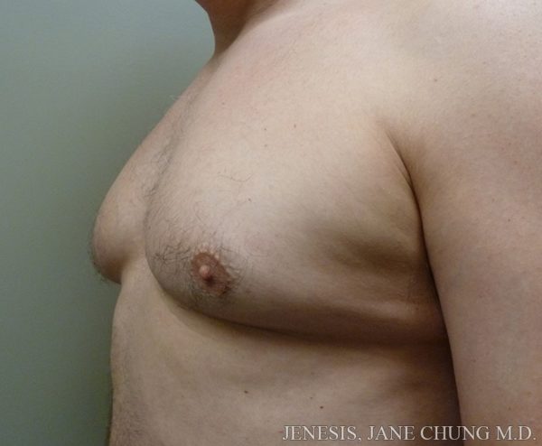 Gynecomastia