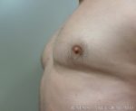 Gynecomastia