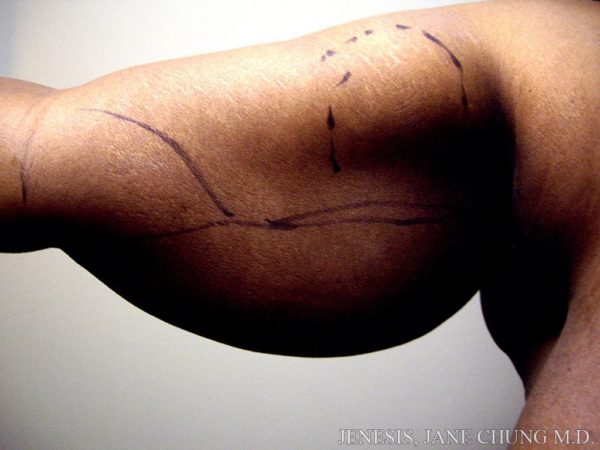 Arms & Upper Body Liposuction