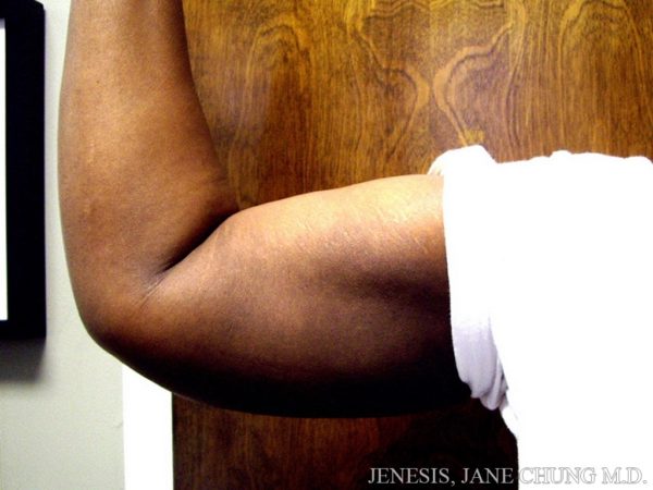 Arms & Upper Body Liposuction