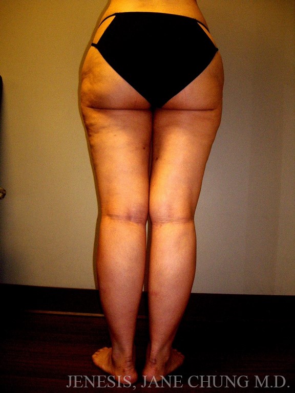 Thighs, Calves, and Ankles Liposuction