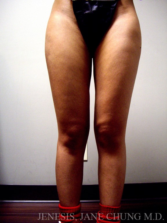 Thighs, Calves, and Ankles Liposuction