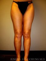 Thighs, Calves, and Ankles Liposuction