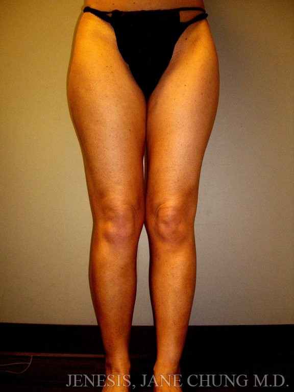 Thighs, Calves, and Ankles Liposuction