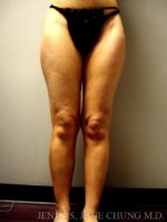 Thighs, Calves, and Ankles Liposuction