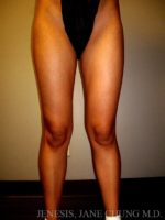 Thighs, Calves, and Ankles Liposuction